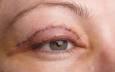 بلفاروپلاستی؛ جراحی برای جوان‌تر شدن چشم‌ها، نه تغییر فرم آن‌ها"