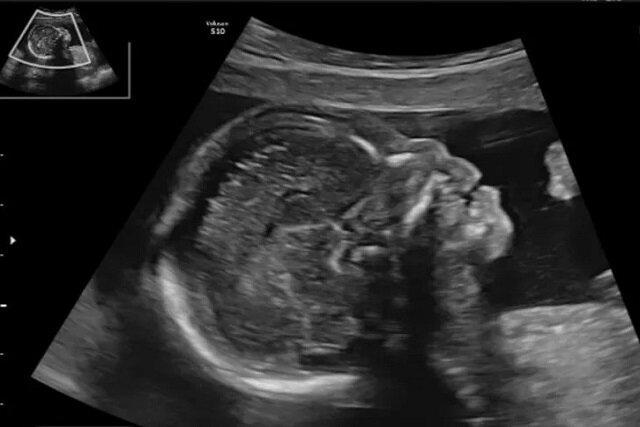 آیا تشخیص زودهنگام «سندرم داون» با شاخص استخوان بینی ممکن است؟