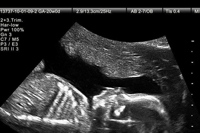پیشرفت‌های تصویربرداری در بارداری؛ تشخیص زودهنگام سندرم داون