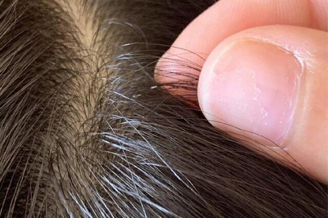 هشدار پزشکی درباره شیوع شپش سر/ آلودگی به معنای رعایت نکردن بهداشت نیست