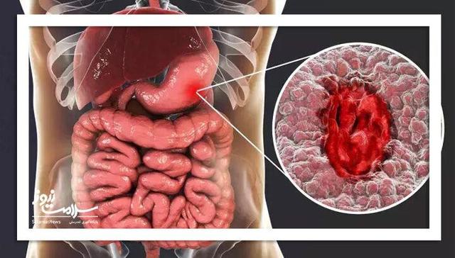 راهنمای غذایی برای بیماران مبتلا به سرطان معده پیشرفته
