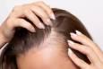 مقصر اصلی ریزش موی ناشی از استرس بالاخره شناسایی شد