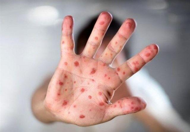 شیوع جهانی سرخک با سرعت/ حتی اگر واکسن زده‌اید باید مراقب این بیماری باشید