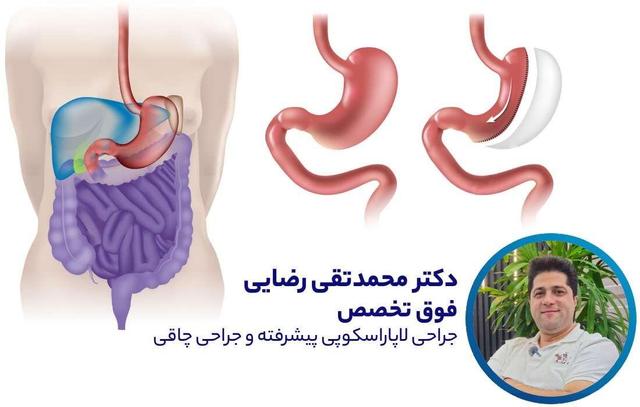 نظر دکتر محمدتقی رضایی متخصص جراحی چاقی در مورد اسلیو معده
