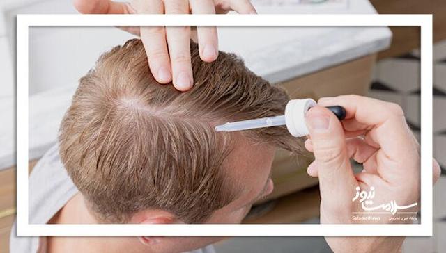 پروکاپیل در مقابل ماینوکسیدیل: کدام برای ریزش مو بهتر است؟