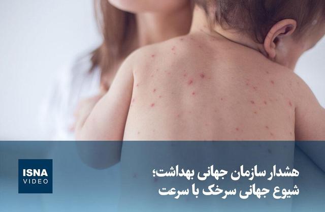 ویدیو/ هشدار سازمان جهانی بهداشت؛ شیوع جهانی سرخک با سرعت