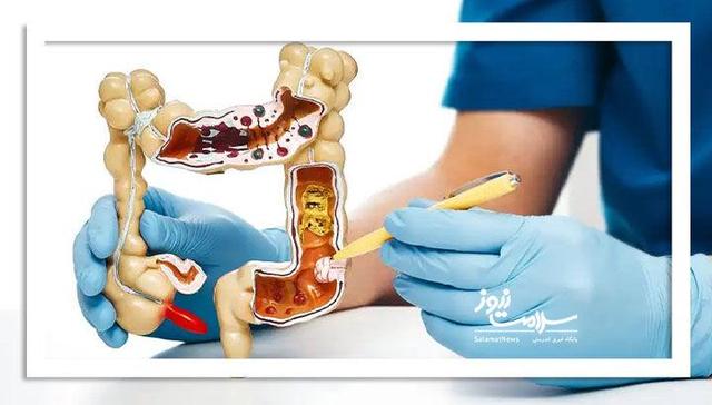 عوامل اصلی رشد سرطانهای گوارشی در ایران،مصرف الکل و دخانیات متهم شماره یک