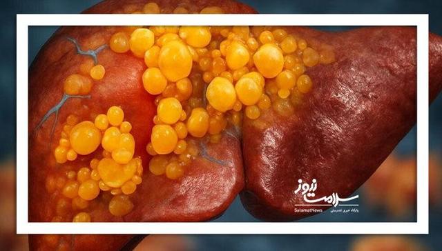 علائمی که نشان دهنده مشکلات کبدی است