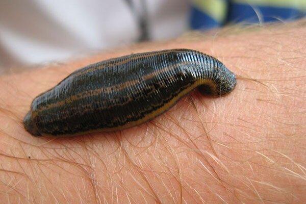 مقابله با بیماری پسوریازیس به کمک زالو درمانی