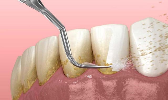 طبیعی‌ترین جرم گیر فوری دندان | سیاه ولیک ؛ بهترین جرم گیر دندان خانگی را بشناسید