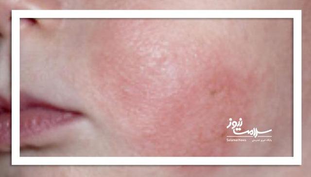 احتمال ابتلای نوزادن به این عوارض پوستی وجود دارد