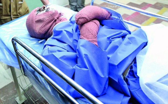 درخواست از رئیس جمهور؛ اول دی روز پیشگیری از سوختگی نامیده شود