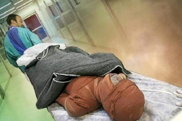 سوختگی در ایران؛ آماری فراتر از حادثه