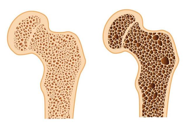 ارتباط تغذیه و پوکی استخوان