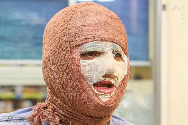 سوختگی در ایران؛ سالی ۳۰۰ هزار سوختگی و زنگ خطر ایمنی