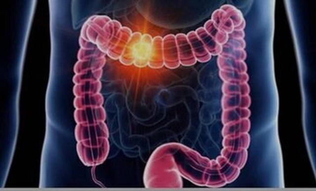 هر خون‌ریزی هموروئید نیست؛ علائم گوارشی را جدی بگیرید