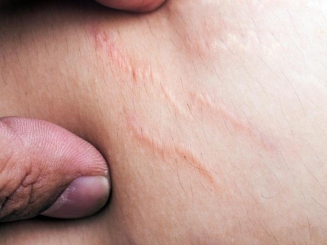 درمان ترکهای پوستی؛ «درمان قطعی» وجود دارد؟