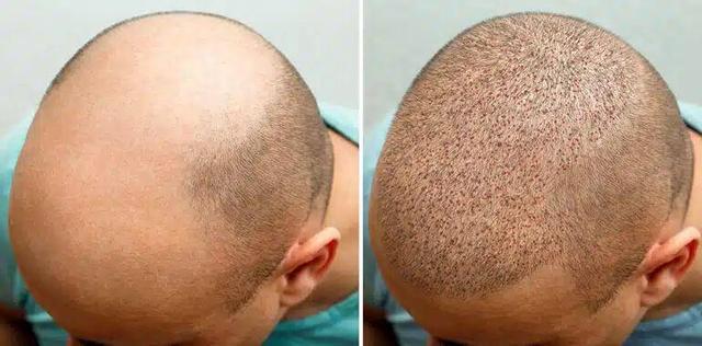 کاشت مو در مشهد | انتخاب آگاهانه برای نتیجه طبیعی و ماندگار