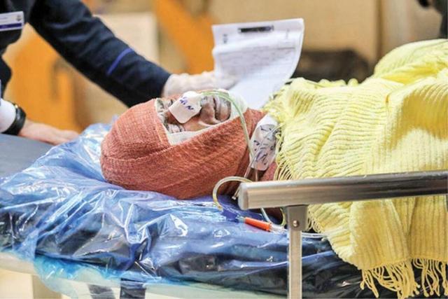 پانسمان‌های نوین سوختگی تحت پوشش بیمه قرار گرفت