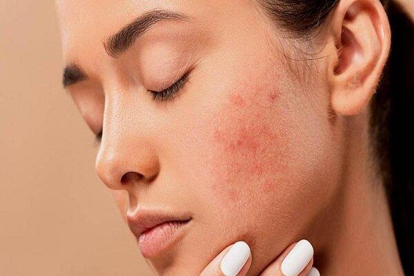 کدام مواد غذایی باعث جوش زدن می‌شود؟