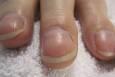 7 علامت ناخن که ممکن است خبر از کلسترول بالا بدهند