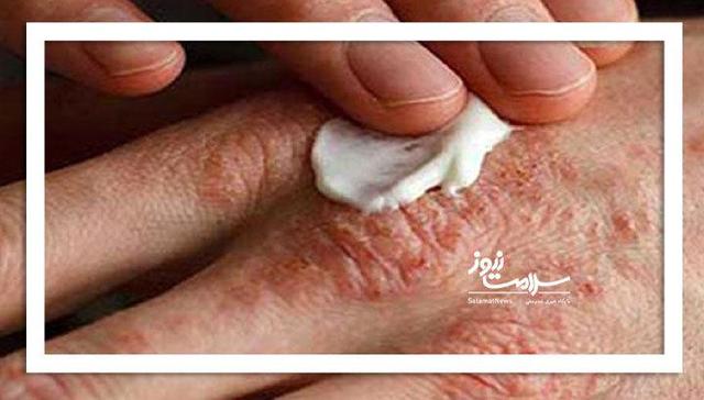 بلایی که خشکی بدن زمستان بر سر بدن می‌آورد