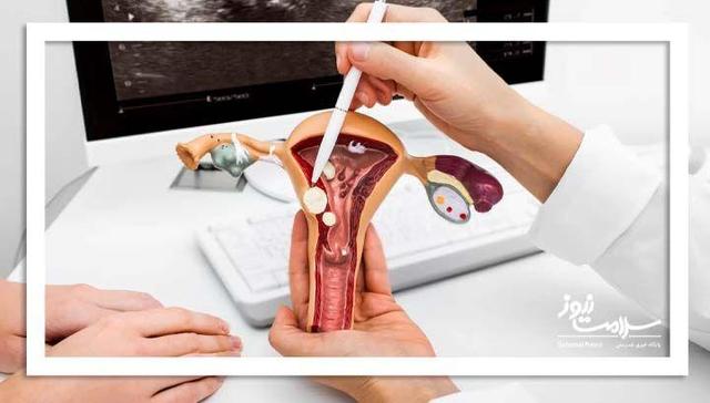 فیبروم رحمی و ارتباط آن با بیماری قلبی در زنان