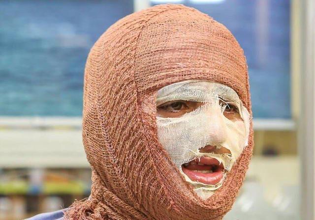 منطقه کاشان بیمارستان تخصصی سوختگی ندارد