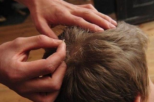 شپش‌زدگی از چالش اجتماعی تا راهکار بهداشتی