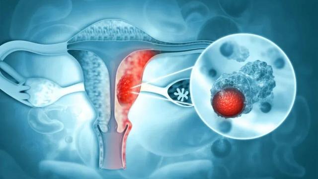 خطر ابتلا به سرطان رحم در چه سنی بیشتر است؟