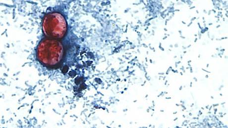 First two US deaths linked to diarrhea-inducing parasite confirmed