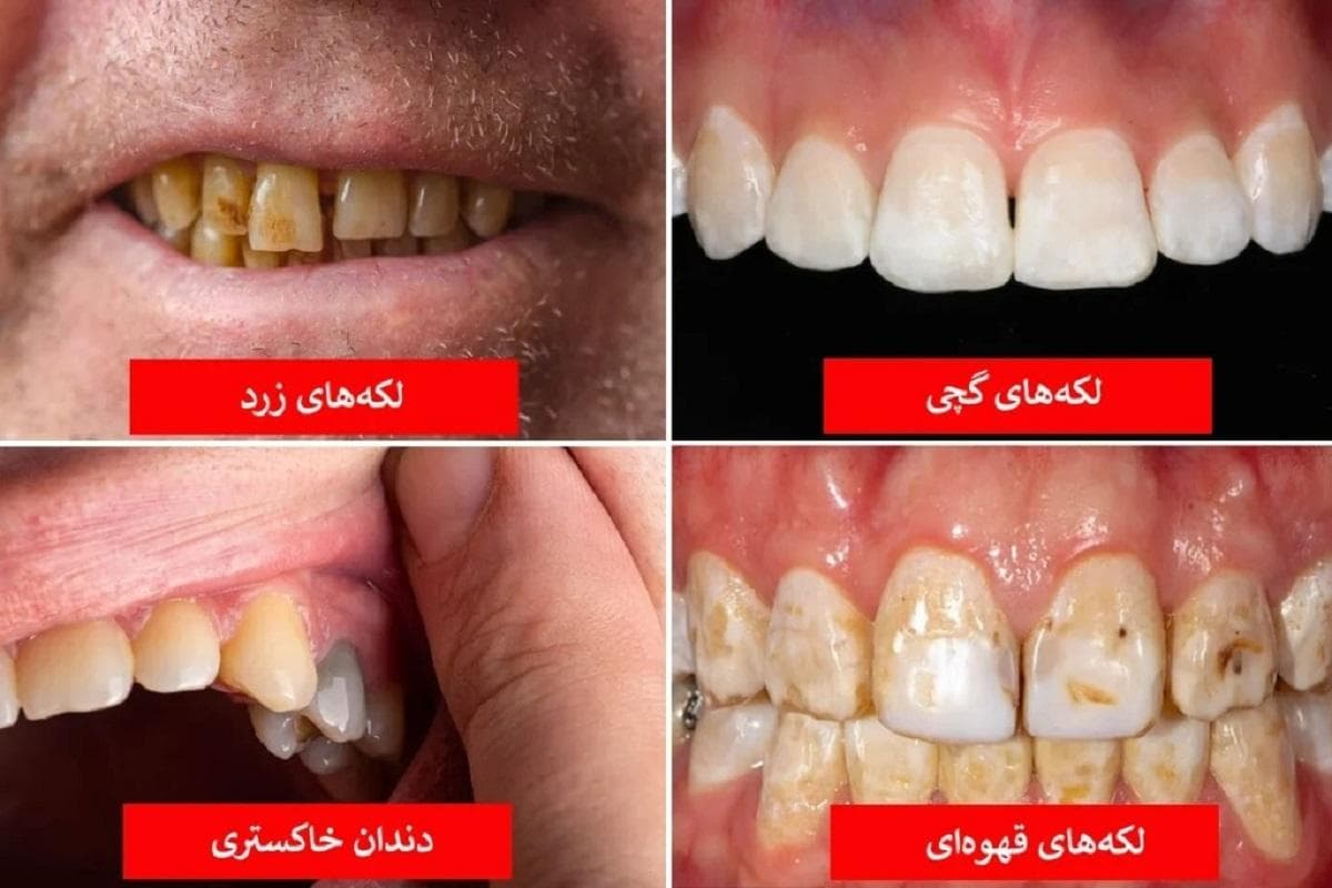 رنگ دندان از دیدگاه علم چه چیزهایی درباره سلامت شما می‌گوید؟(+عکس)
