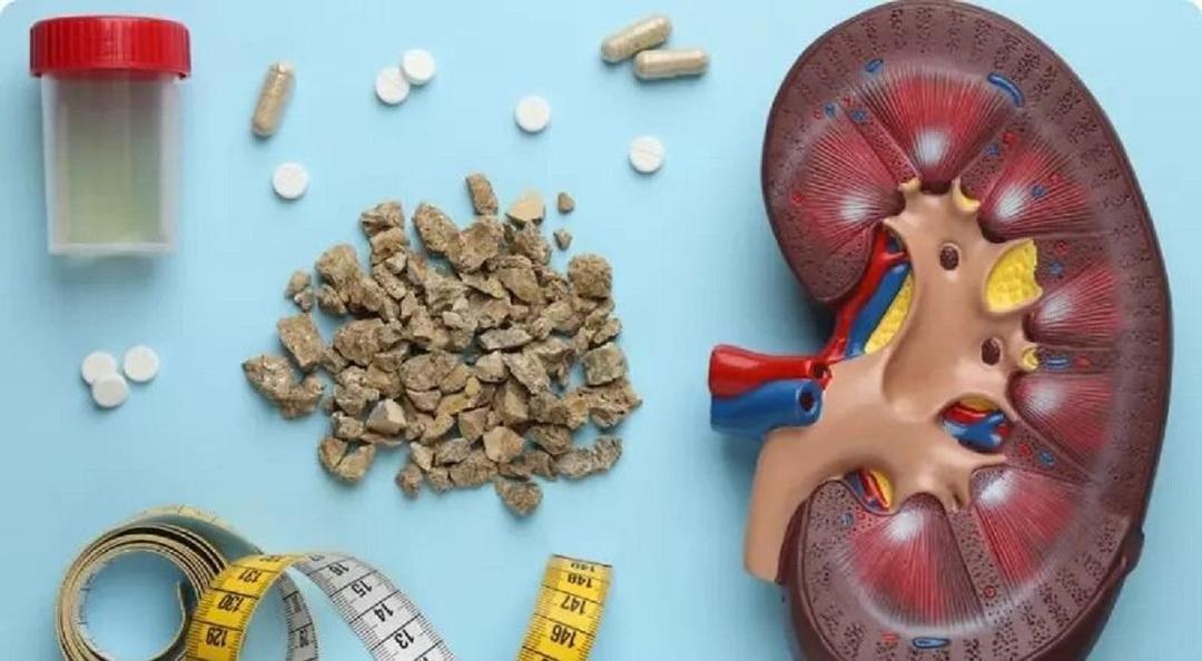 مصرف مشروبات الکلی تاثیری در روند بهبود سنگ کلیه دارد؟