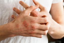 ابزار مؤثر برای کنترل اگزما