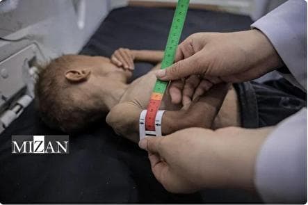 پیامد‌های فاجعه‌بار سوءتغذیه و گرسنگی بر ساکنان غزه؛ ورود غذا به‌تنهایی کافی نیست