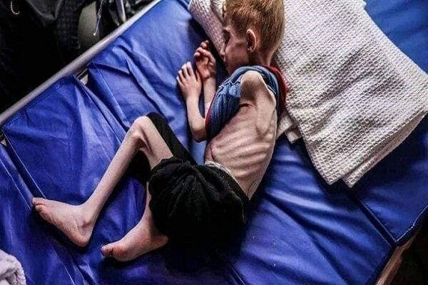 هشدار یونیسف درباره سوءتغذیه شدید ۱۳هزار کودک در غزه