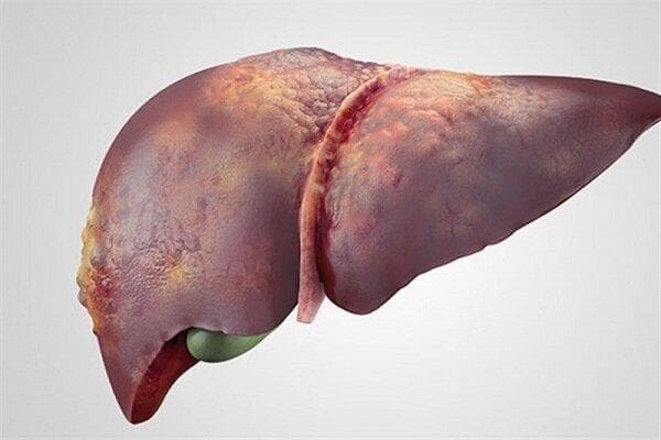 تشخیص هپاتیت از روی صورت