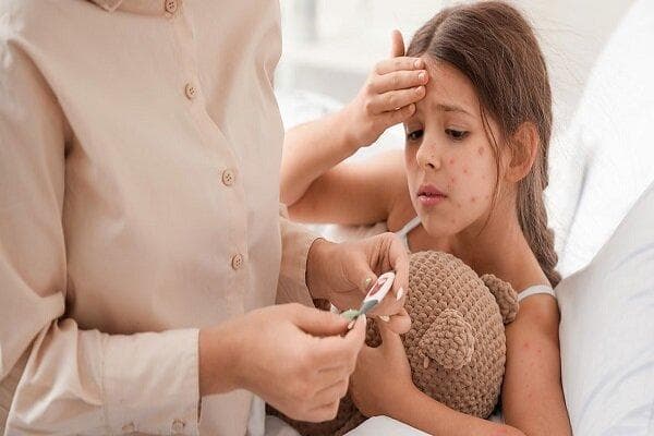 عوارض بروز آبله‌مرغان در بزرگسالی / توصیه تزریق واکسن در گروه‌های پرخطر