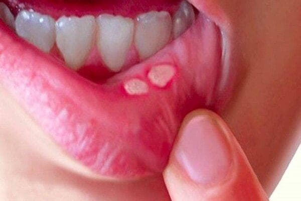 تفاوت‌های کلیدی آفت و زگیل دهانی