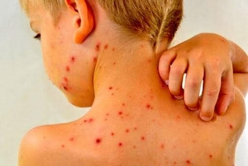امسال این دو شهر بیشترین مبتلایان سرخک را داشتند | ۳۵ درصد مبتلایان کودکان زیر یک سال