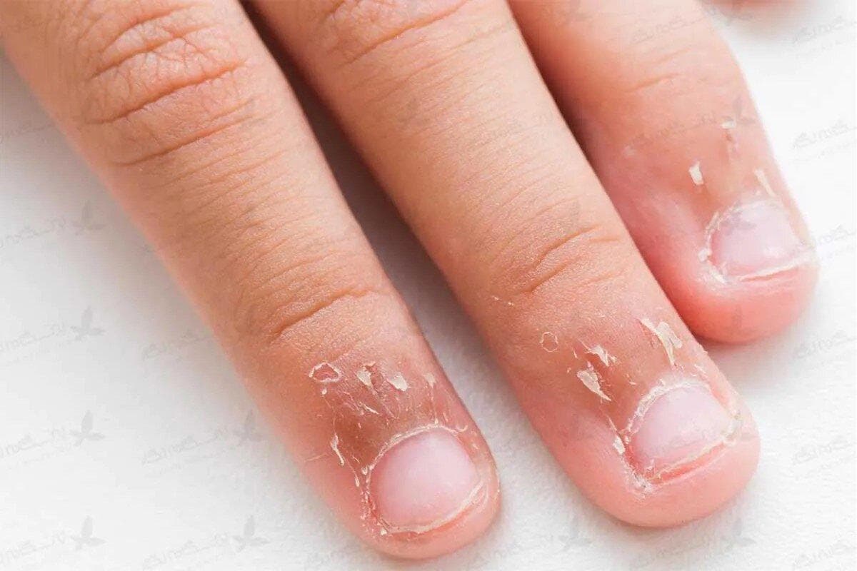 علت پوست‌پوست شدن اطراف ناخن و روش‌های درمان