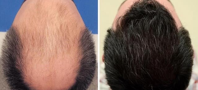 آیا کاشت مو دائمی است یا احتمال ریزش مجدد وجود دارد؟ بررسی واقعیت‌ها