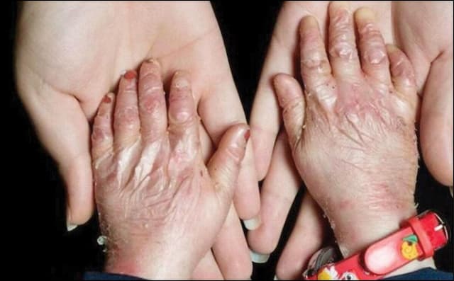 تأثیر خطرناک قطعی‌های مکرر آب و برق بر بیماران پروانه‌ای
