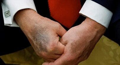 واکنش ونس به کبودی دست ترامپ/ اتفاقات وحشتناکی رخ داده است!
