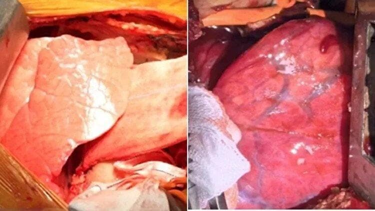 نخستین پیوند ریه خوک به انسان انجام شد