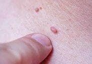 هر آنچه باید درباره بیماری HPV بدانید