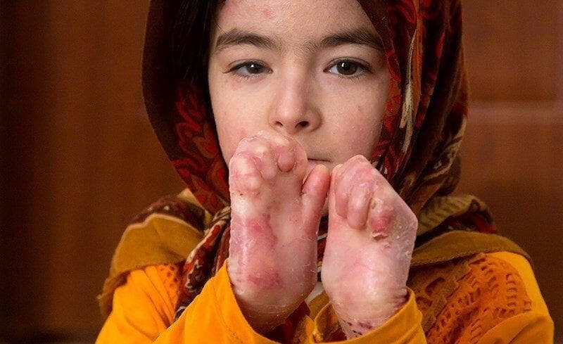 تجدید فراخوان تامین پانسمان‌های بیماران پروانه ای