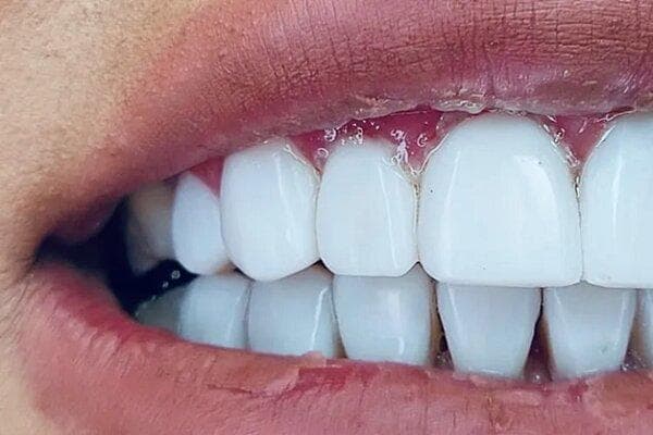 کدام کلینیک انتخاب اول برای لمینت دندان در شرق تهران است؟