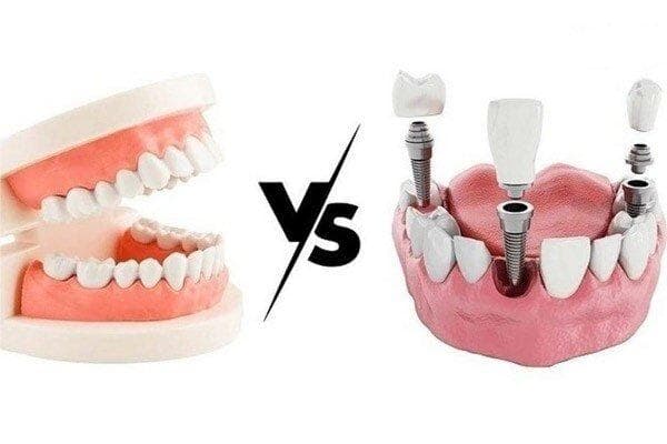 ایمپلنت دندان بهتر است یا دندان مصنوعی؟ بررسی تخصصی و مقایسه هزینه‌ها
