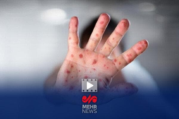 حذف سرخک و سرخجه در ایران؛ افتخاری در سایه همسایگی با کانون‌های بیماری